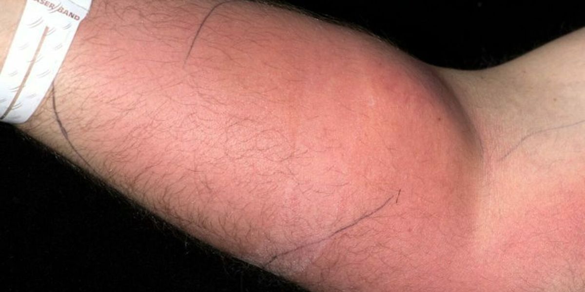 Inyección de semen en el antebrazo