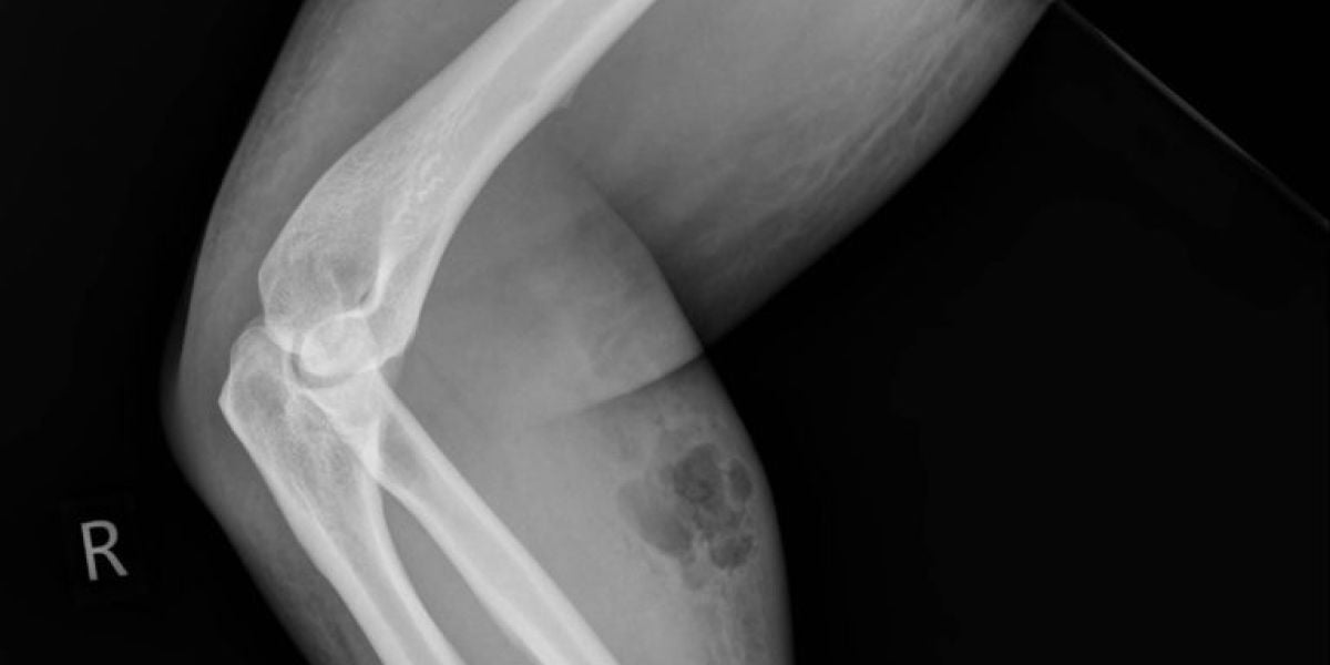 Hospitalizado por inyectarse semen en el antebrazo