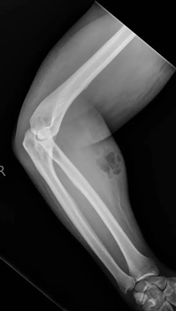 Hospitalizado por inyectarse semen en el antebrazo Hospitalizado por inyectarse semen en el antebrazo