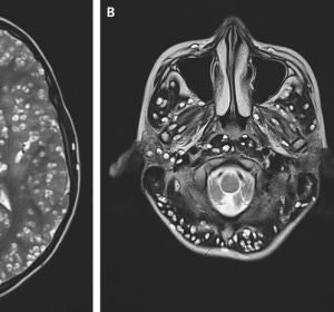 Cerebro del joven infectado con gusanos Cerebro del joven infectado con gusanos