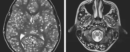 Cerebro del joven infectado con gusanos Cerebro del joven infectado con gusanos