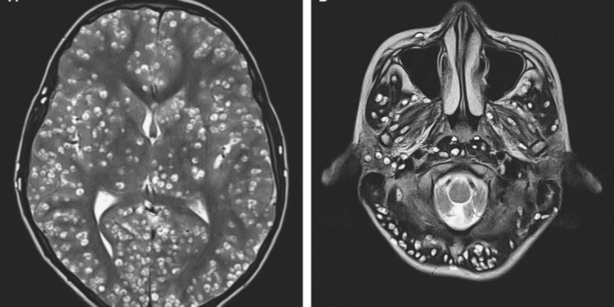 Cerebro del joven infectado con gusanos