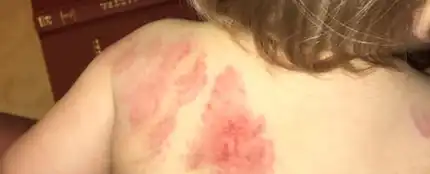 Las mordeduras del bebé Las mordeduras del bebé