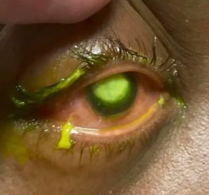 Las consecuencias de dormir con lentillas Las consecuencias de dormir con lentillas
