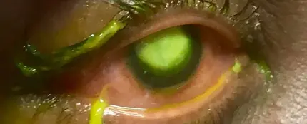 Las consecuencias de dormir con lentillas Las consecuencias de dormir con lentillas