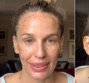 Imagen de Carola Baleztena con la cara quemada Imagen de Carola Baleztena con la cara quemada