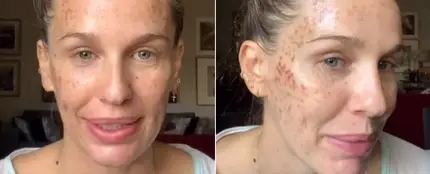 Imagen de Carola Baleztena con la cara quemada Imagen de Carola Baleztena con la cara quemada