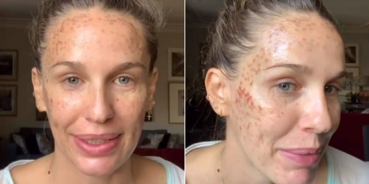 Imagen de Carola Baleztena con la cara quemada