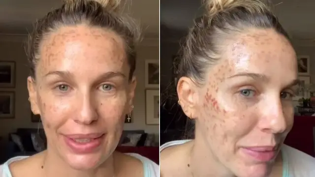 Imagen de Carola Baleztena con la cara quemada