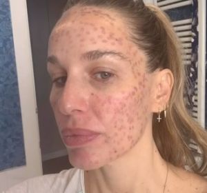 Imagen de Carola Baleztena con la cara quemada Imagen de Carola Baleztena con la cara quemada