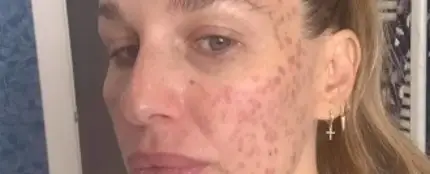 Imagen de Carola Baleztena con la cara quemada Imagen de Carola Baleztena con la cara quemada