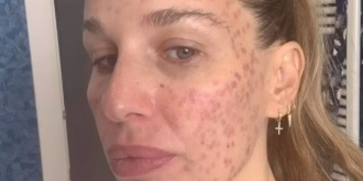Imagen de Carola Baleztena con la cara quemada