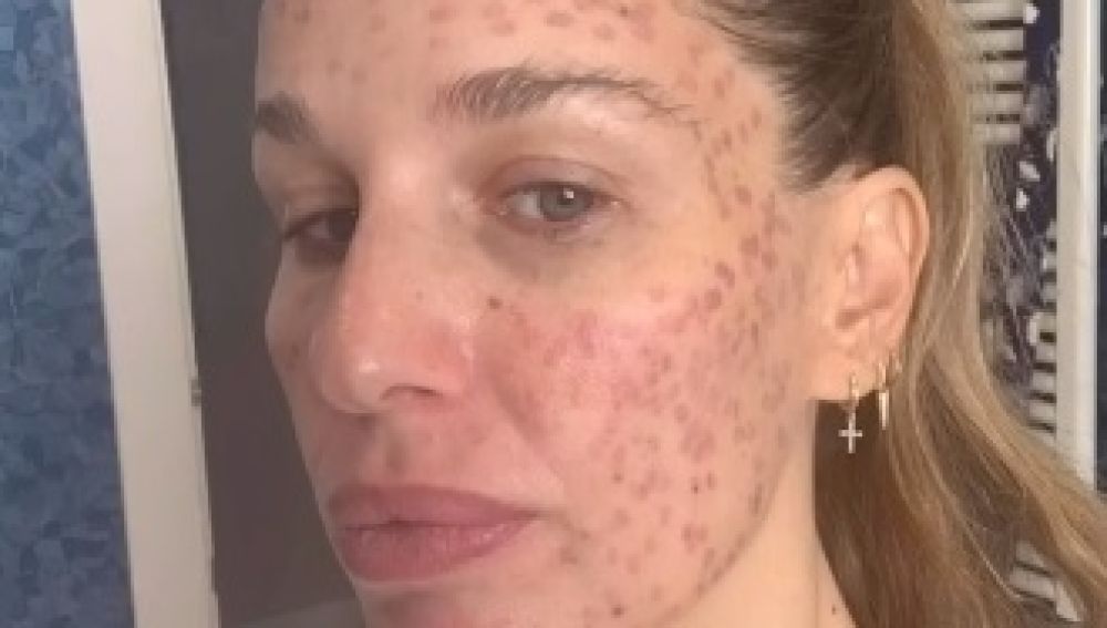 Noveno Inmundicia hemisferio Carola Baleztena publica un vídeo de su cara 25 días después de su  incidente en una clínica de estética | Europa FM
