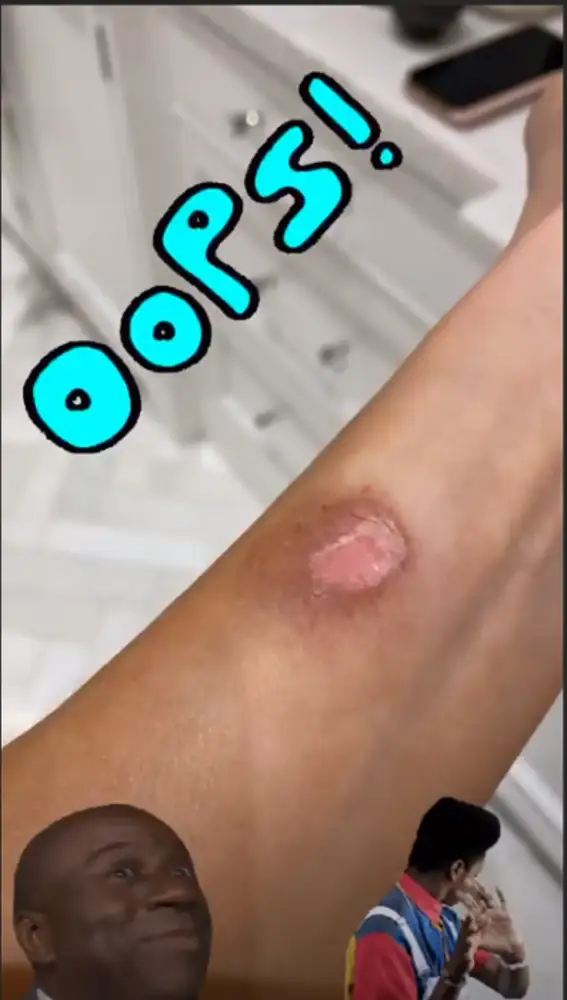 La quemadura de Thalía La quemadura de Thalía