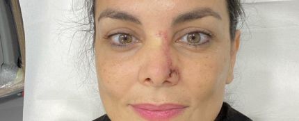 Mónica Carrillo muestra la cicatriz de su nariz tras recuperarse de un cáncer de piel