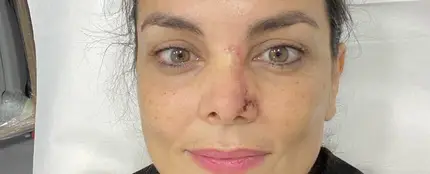 Mónica Carrillo muestra la cicatriz de su nariz tras recuperarse de un cáncer de piel Mónica Carrillo muestra la cicatriz de su nariz tras recuperarse de un cáncer de piel