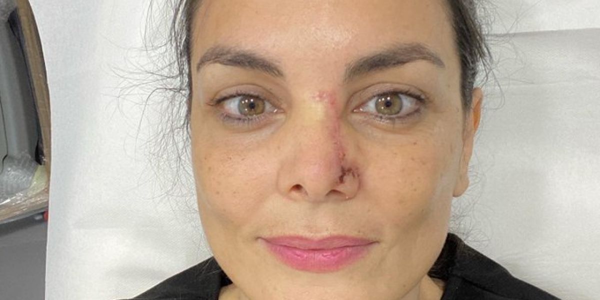 Mónica Carrillo muestra la cicatriz de su nariz tras recuperarse de un cáncer de piel