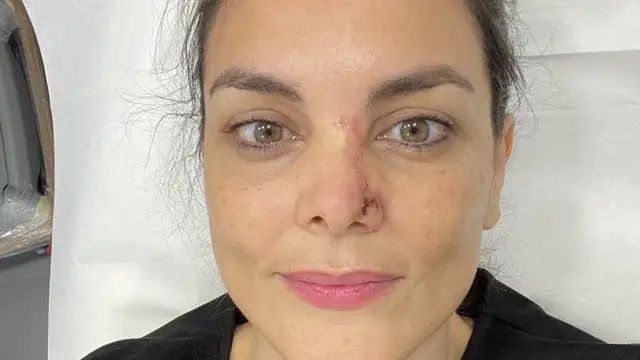 Mónica Carrillo muestra la cicatriz de su nariz tras recuperarse de un cáncer de piel