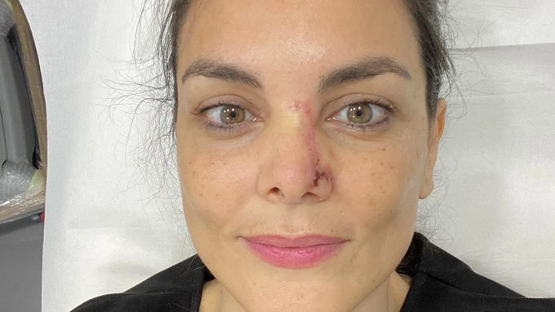 Mónica Carrillo muestra la cicatriz de su nariz tras recuperarse de un cáncer de piel Mónica Carrillo muestra la cicatriz de su nariz tras recuperarse de un cáncer de piel