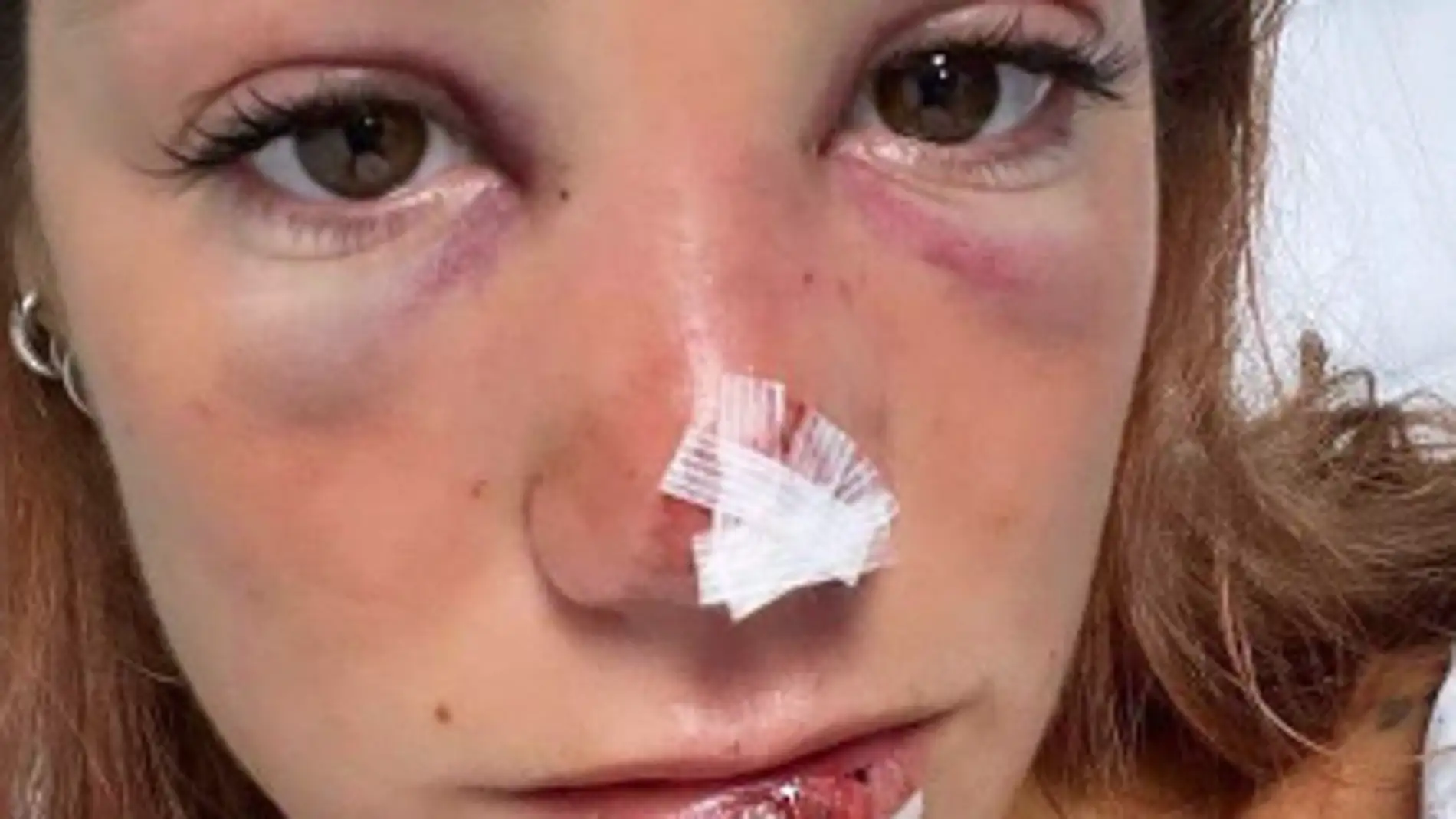 Miri Pérez muestra sus heridas tras un grave accidente de moto