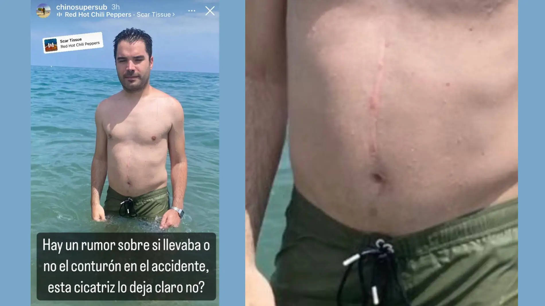 José 'Chino 'de Supersubmarina muestra su cicatriz en Instagram